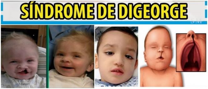 caracteristicas del sindrome de digeorge