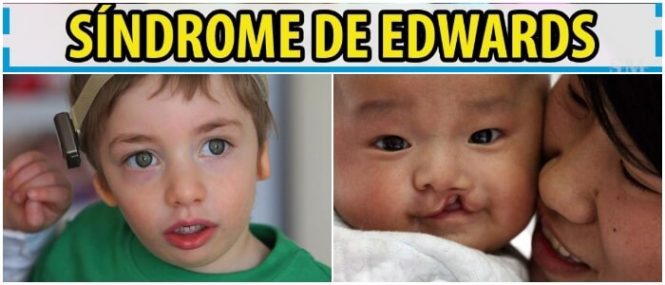 fenotipo del sindrome de edwards