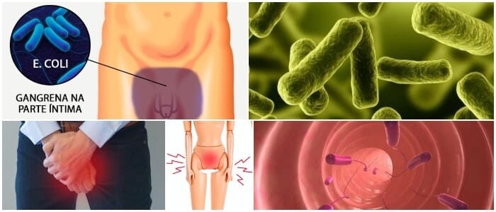 antibioticos para el sindrome de fournier