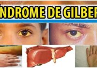 sindrome de gilbert y alcohol