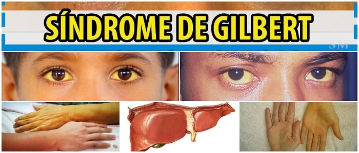 sindrome de gilbert y alcohol