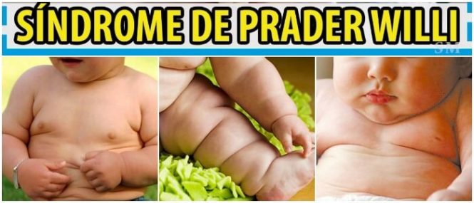 causas y tratamiento del sindrome de prader willi