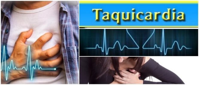 definicion de taquicardia ventricular