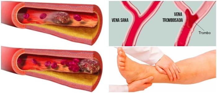 fisiopatologia de la triada de virchow