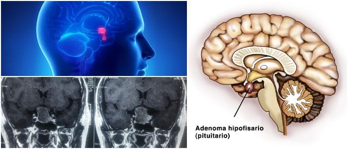 tipos de adenoma hipofisario