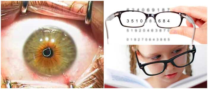 cirugía ocular para astigmatismo miópico