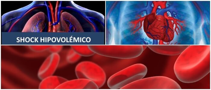 Choque O Shock Hipovolémico ¿qué Es Causas Síntomas Diagnóstico Y Tratamiento Arriba Salud 