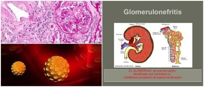 tipos de glomerulonefritis