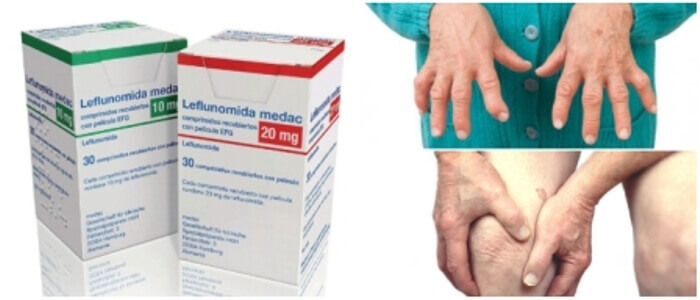 la leflunomida como tratamiento para la artritis en las manos