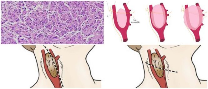 que es el paraganglioma adrenal