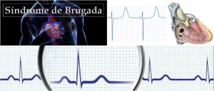 sindrome de brugada latente