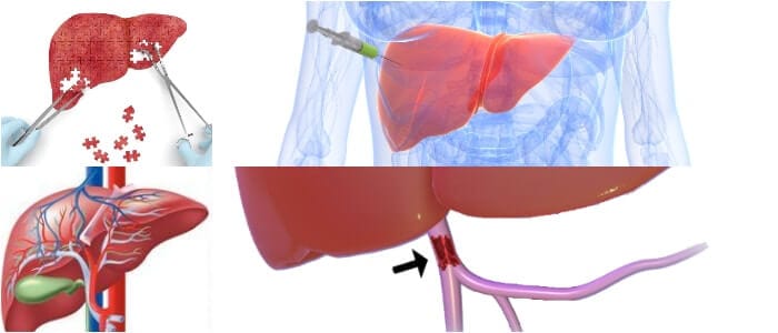 sistema porta hepático formado por