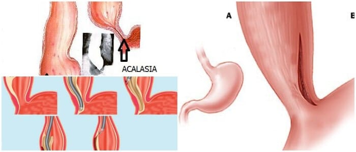 que es la acalasia esofagica