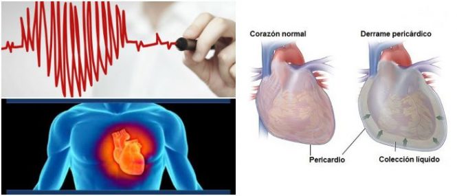 cuales son las causas del derrame pericárdico