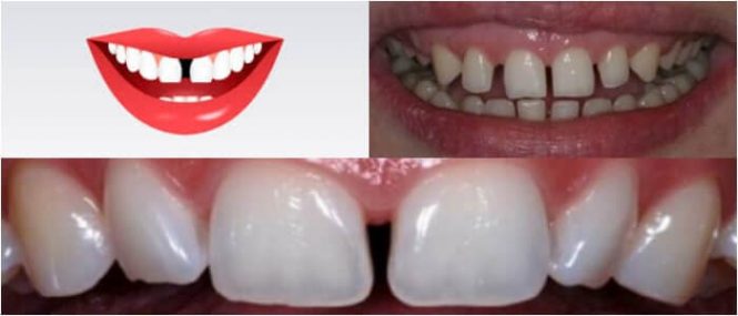 diastema dental