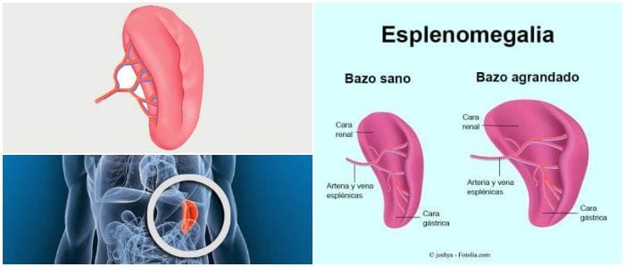 causas de la esplenomegalia