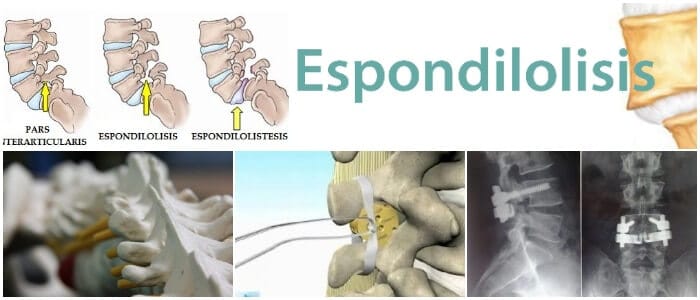 que es la espondilitis anquilosante