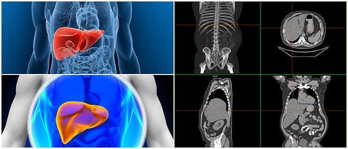 cuales son las causas de la hepatomegalia