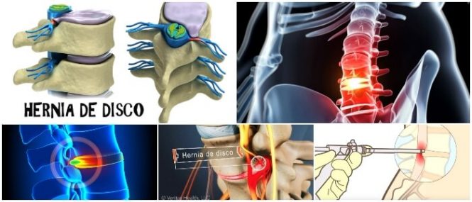 que es la hernia de disco dorsal