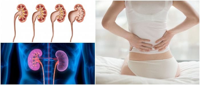 que es la hidronefrosis bilateral fetal