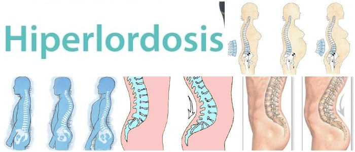 Hiperlordosis Definición Signos Síntomas Causas Diagnóstico Y Tratamiento Arriba Salud 1079