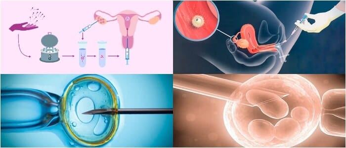 cual es la tasa de éxito de la inseminación in vitro
