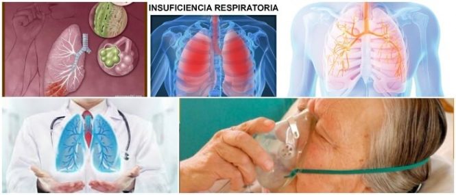 que es la insuficiencia respiratoria aguda