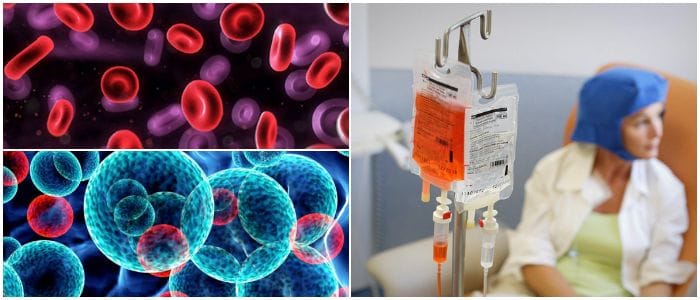 cuale son las etapas de la leucemia linfocítica crónica