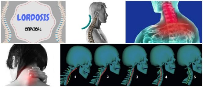 consecuencias de la lordosis cervical bilateral