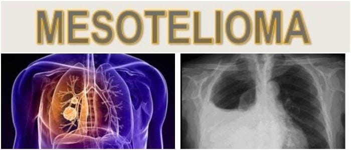 consecuencias de el mesotelioma maligno