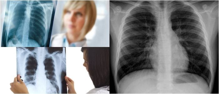 la radiografía de tórax y tuberculosis
