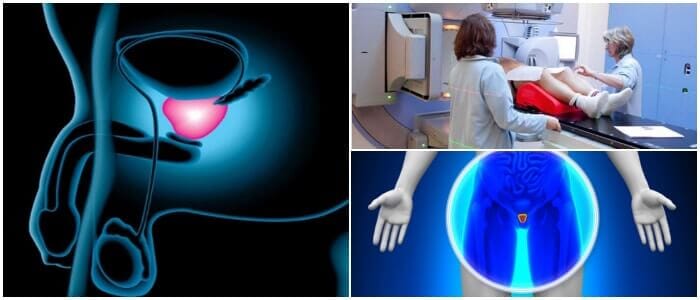 dieta para la radioterapia de prostata