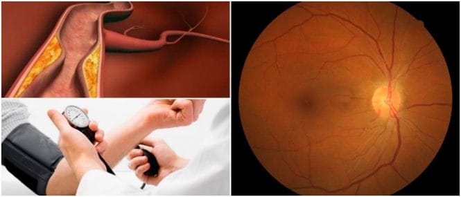 cuales son los grados de la retinopatia hipertensiva