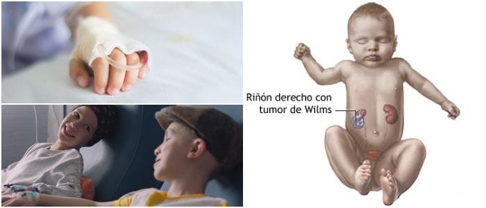 tumor de wilms en niños
