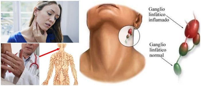 diferencias entra la adenomegalia y adenopatia