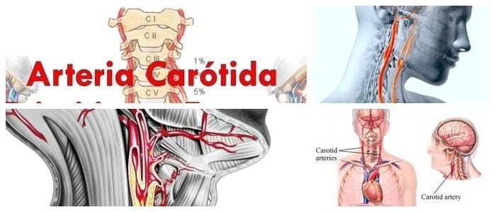 consecuencias de la arteria carótida bloqueada