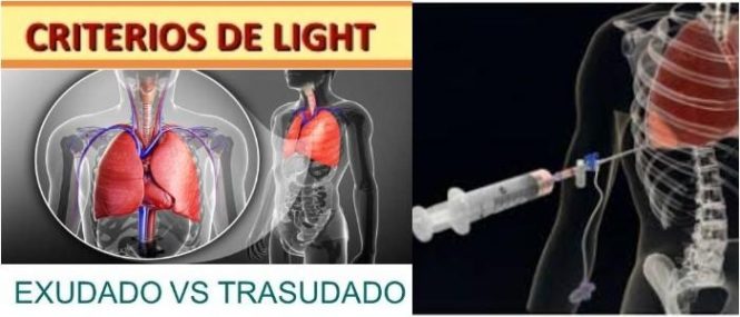 cuales son los criterios de light exudado