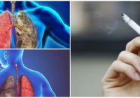 cuales son las etapas del cáncer pulmonar