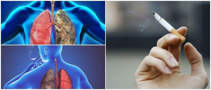 cuales son las etapas del cáncer pulmonar
