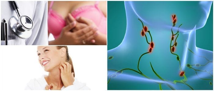 linfadenopatía en el cuello