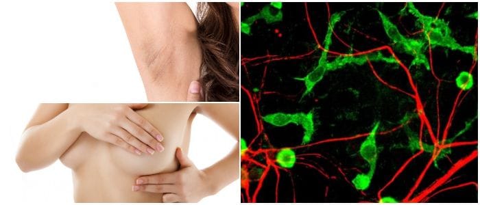 relación entre los linfonodos axilares y cáncer de mama