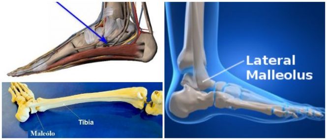 consecuencias de una bursitis maleolo externo