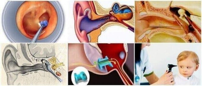 cuales son las complicaciones de la miringotomia en adultos