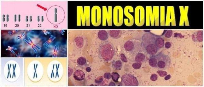 cual es la biología de la monosomia