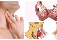 consecuencias de los nódulos tiroideos benignos