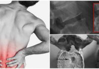 por que los nódulos de schmorl generan dolor de espalda