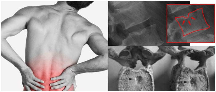por que los nódulos de schmorl generan dolor de espalda