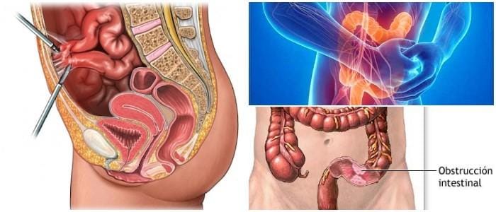 obstruccion intestinal en niños