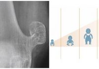 que es el osteocondromatosis múltiple