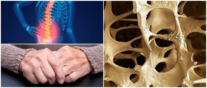 que es la osteoporosis aguda